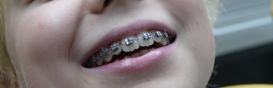 Kieferorthopädie für Kinder